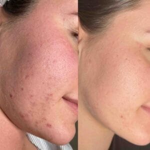 Microneedling