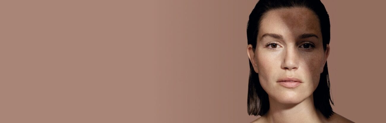 Pigmentflecken und Hyperpigmentierung