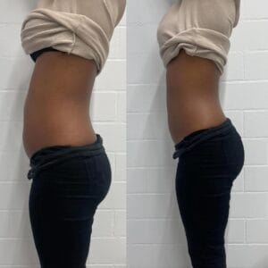 Vorher-Nachher-Bild eines Bauchs, links zeigt einen leicht vorstehenden Bauch, rechts einen flachen und definierten Bauch nach einer Behandlung.