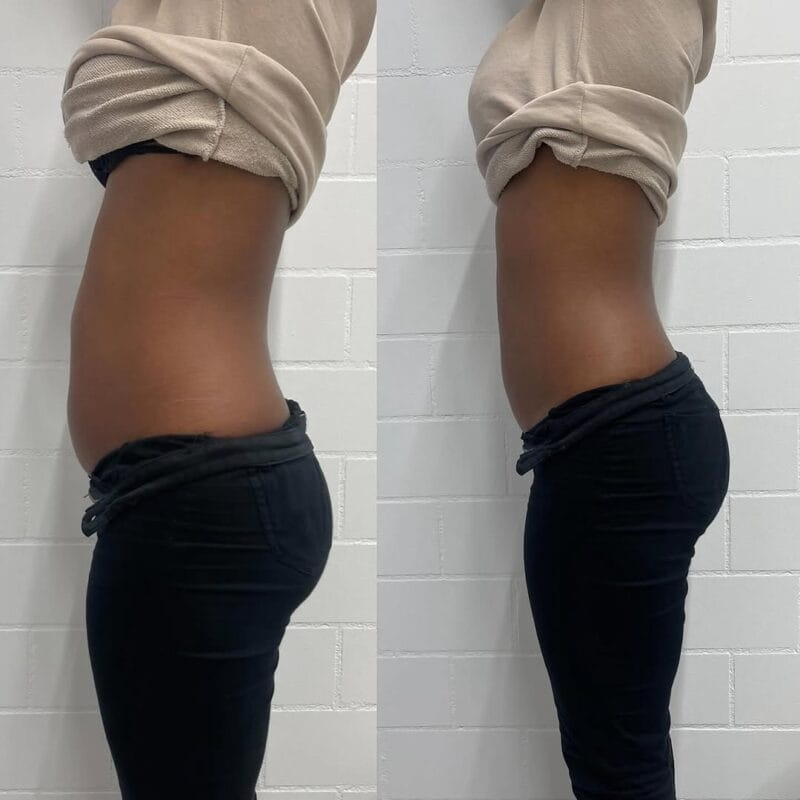 Vorher-Nachher-Bild eines Bauchs, links zeigt einen leicht vorstehenden Bauch, rechts einen flachen und definierten Bauch nach einer Behandlung.