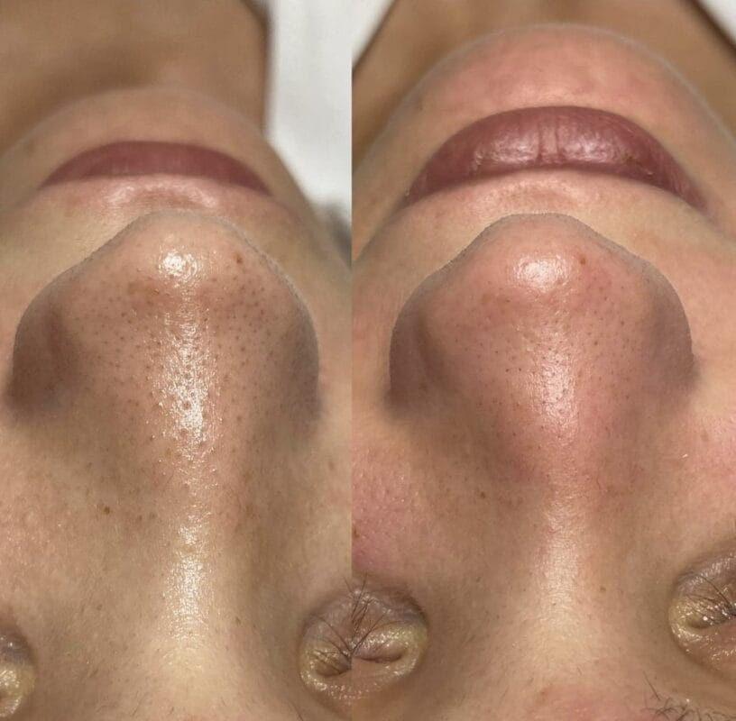 Vorher-Nachher-Ergebnis einer Beautymaster-Behandlung zur Verfeinerung der Poren bei Mel’s Beauty & Academy in 5212 Hausen AG.