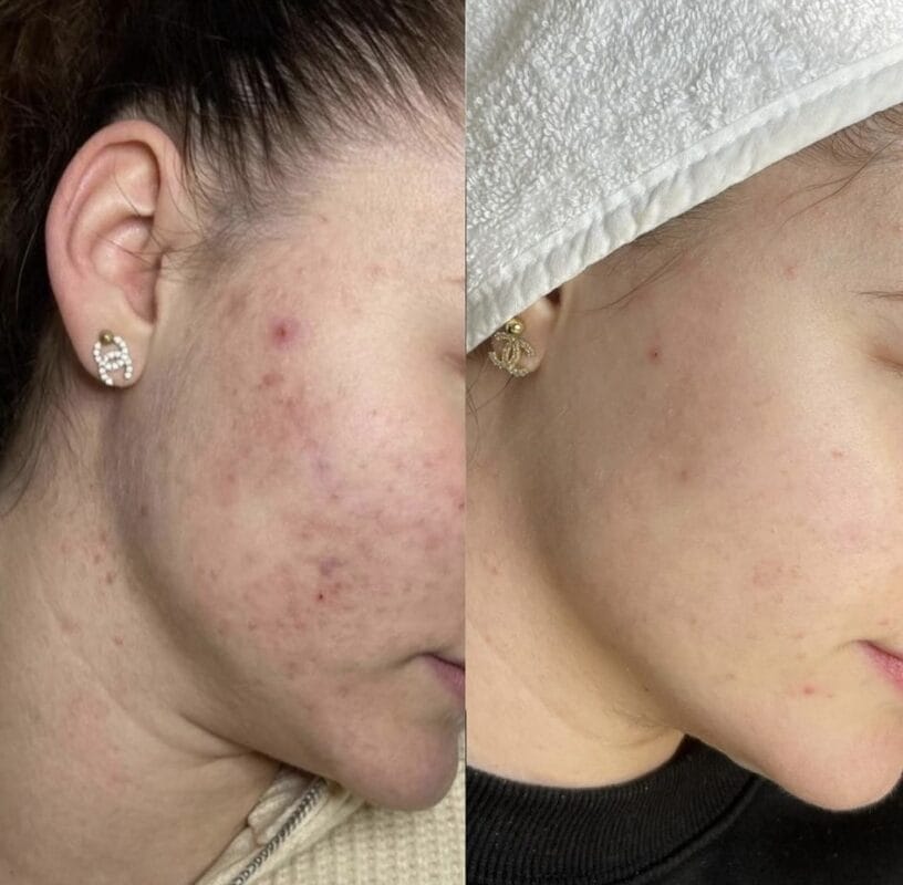 Vorher-Nachher-Ergebnis einer Mesoskin-Behandlung zur Reduktion von Aknenarben und Hautverfeinerung bei Mel’s Beauty & Academy in 5212 Hausen AG.