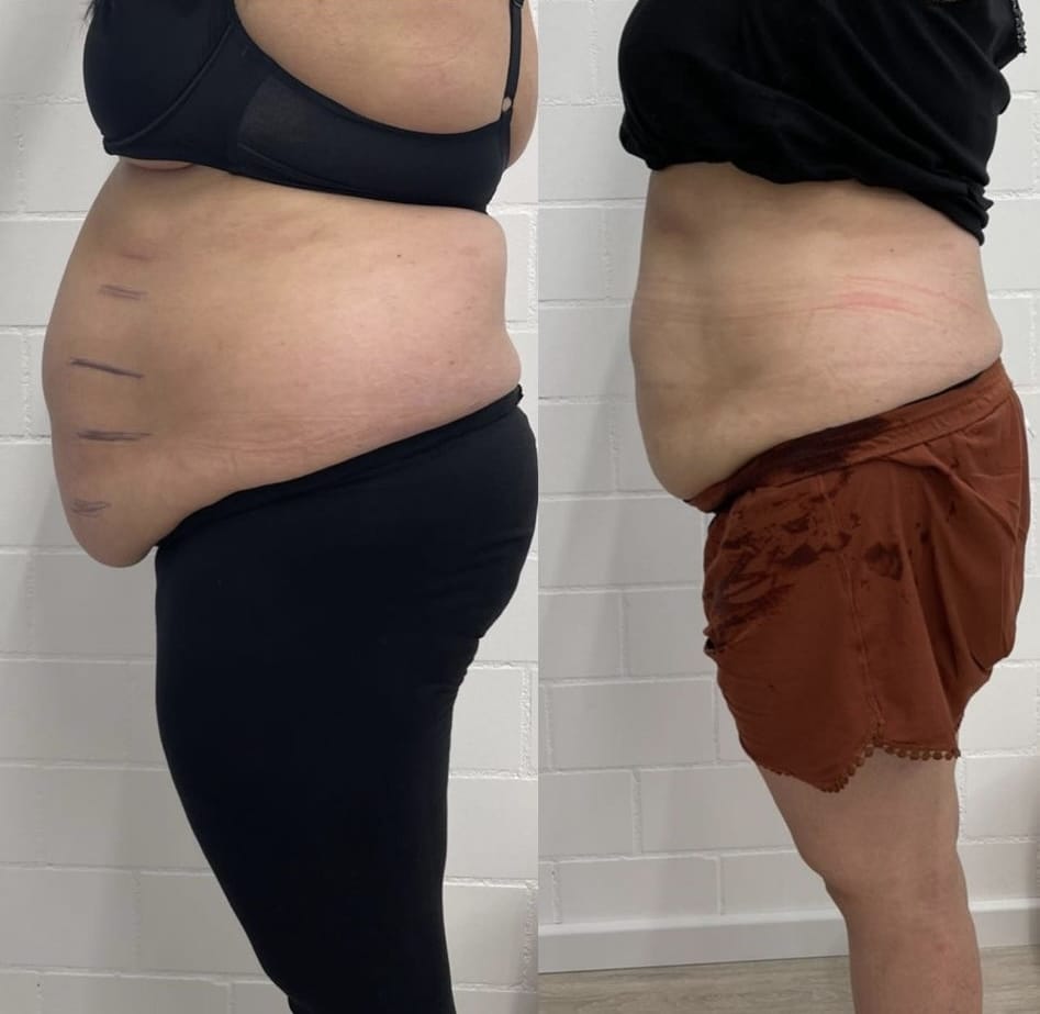 Vorher-Nachher-Ergebnis einer Dipotens- und Rasping-Behandlung zur Reduktion von Bauchfett bei Mel’s Beauty & Academy.