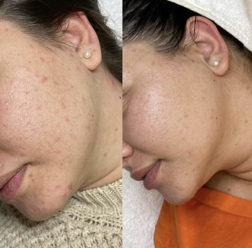Vorher-Nachher-Ergebnis einer Mesopeel-Behandlung zur Verbesserung des Hautbildes und Reduktion von Unreinheiten bei Mel’s Beauty & Academy in 5212 Hausen AG.