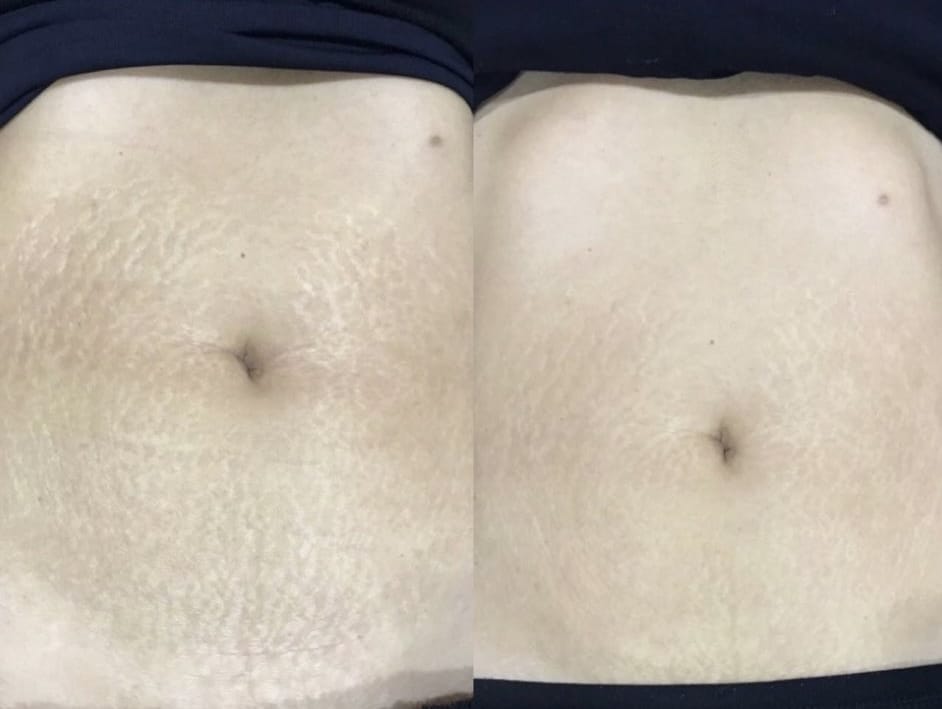 Vorher-Nachher-Ergebnis einer Fibroderms XS-Behandlung zur Reduktion von Dehnungsstreifen bei Mel’s Beauty & Academy in 5212 Hausen AG.
