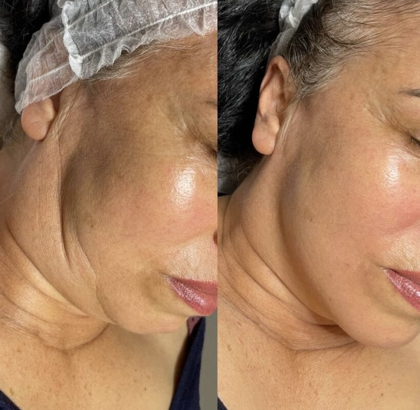 Vorher-Nachher-Ergebnis einer Mesoéclat-Behandlung zur Reduktion von Falten und Hautverjüngung bei Mel’s Beauty & Academy in 5212 Hausen AG.