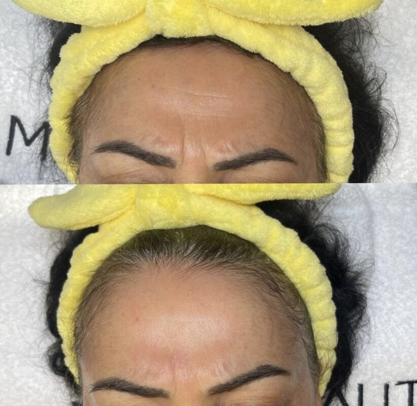 Vorher-Nachher-Ergebnis einer Skinbooster-Behandlung zur Reduktion von Stirnfalten und Hautglättung bei Mel’s Beauty & Academy.