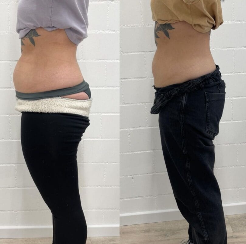 Vorher-Nachher-Bild eines iREJU-Behandlungsergebnisses, bei dem die Bauchpartie einer Kundin sichtbar gestrafft und geglättet wurde.