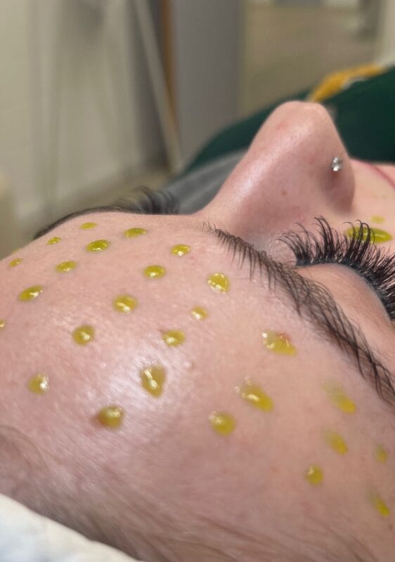 Nahaufnahme einer BioRePeelCl3 Behandlung auf der Stirn einer Kundin mit gelblichen Wirkstoff-Tropfen für eine glattere und regenerierte Haut.