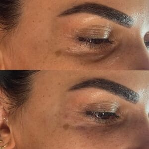 Vorher-Nachher-Bild nach Lumi Eyes Behandlung