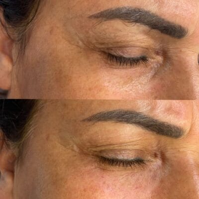 Vorher-Nachher-Bild der Augenpartie mit reifer Haut nach Lumi Eyes Behandlung