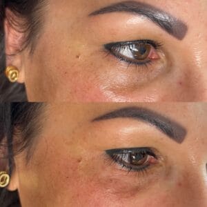 Vorher-Nachher-Ergebnis bei starken Augenringen