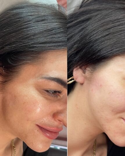 Profhilo Vorher-nachher Behandlung – Haut wirkt nach der Anwendung glatter, frischer und strahlender