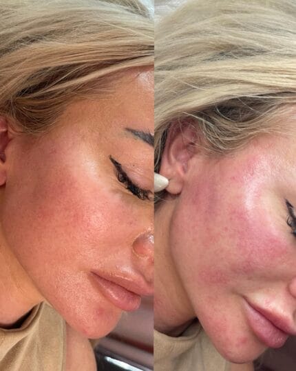 Profhilo Behandlung – Vorher-nachher Bild mit sichtbarer Verbesserung der Hautstruktur und Ausstrahlung