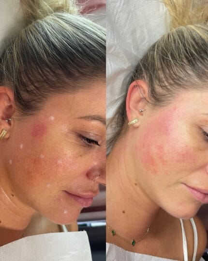 Vorher-nachher Vergleich nach Profhilo Gesichtsbehandlung – sichtbare Verbesserung der Hautstruktur