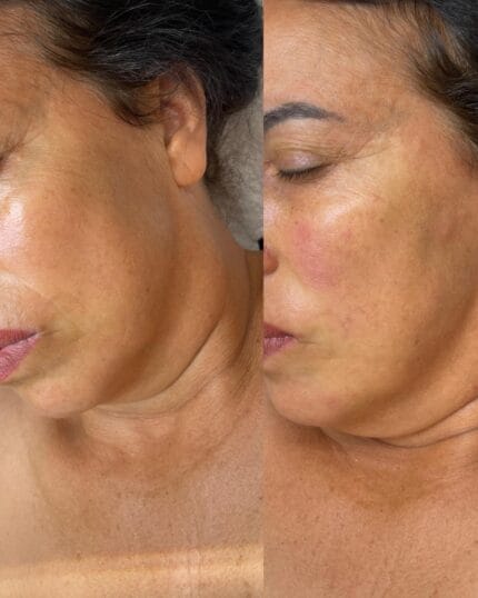 Sofort sichtbarer Lifting-Effekt nach der Profhilo Behandlung – linke Gesichtshälfte vorher & nachher im Vergleich