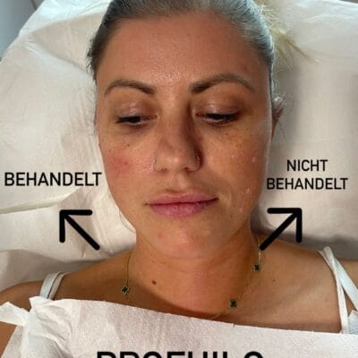 Vorher-Nachher Vergleich nach Profhilo Gesichtsbehandlung – linke Gesichtshälfte sichtbar geglättet, rechte unbehandelt