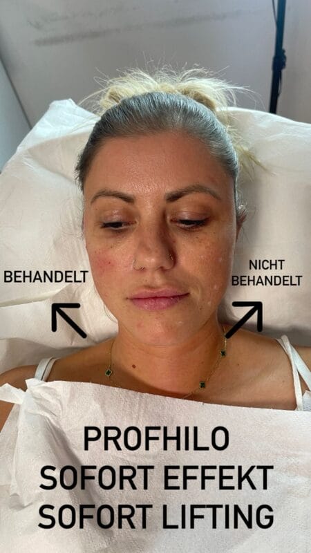 Vorher-Nachher Vergleich nach Profhilo Gesichtsbehandlung – linke Gesichtshälfte sichtbar geglättet, rechte unbehandelt