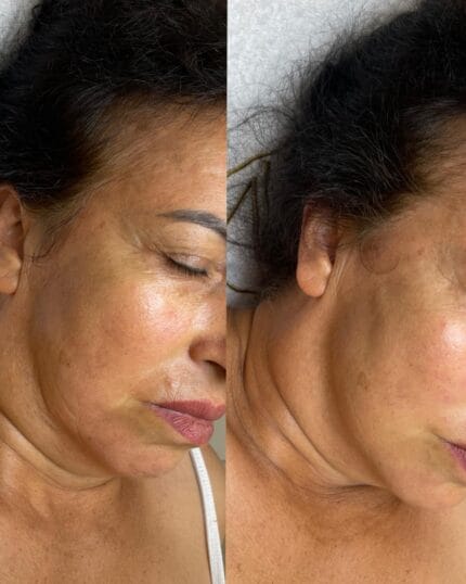 Vorher-nachher Profhilo Behandlung – rechte Gesichtshälfte mit frischem Glow und Lifting-Effekt