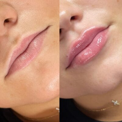 Filler Behandlungen Hausen AG – Lippenaufspritzung vorher nachher