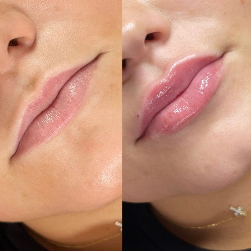 Filler Behandlungen Hausen AG – Lippenaufspritzung vorher nachher